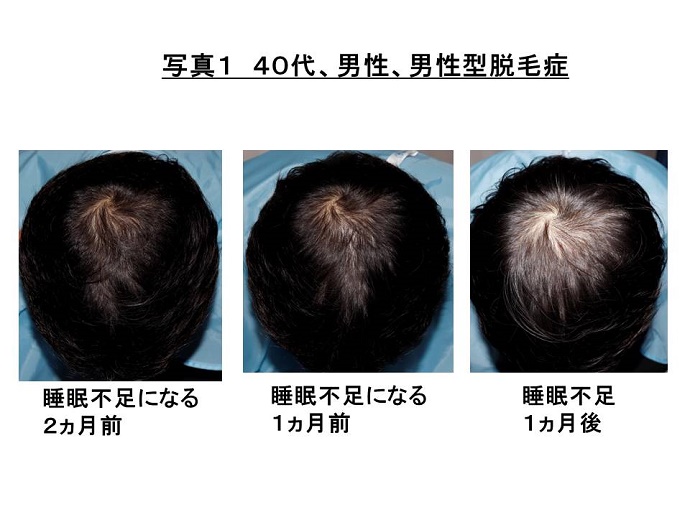 円形脱毛症　病院
